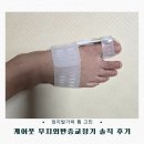 엄지발가락 휨이 고민이라면? 케어풋 무지외반증교정기 솔직 후기