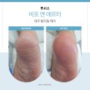 김혜진클리닉 | 대구 발각질 관리샵 제거잘하는곳 풋시스에서 인생 케어 풋시스 후기