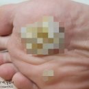 보명한의원 | 보명한의원) 족저사마귀 치료후기/백아율크림