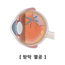 망막 박리(Retinal detachments &amp; breaks) 눈 질환이란? 이미지