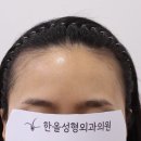 은혜헤어라인 이미지