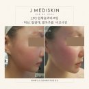 (주)제이메디 | 송도 이중턱, 다이어트를 해도 볼살만 빠진다고?