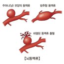 뇌동맥류(뇌동맥꽈리 ; cerebral aneurysm) 이미지