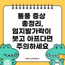 통풍 증상 총정리, 엄지발가락이 붓고 아프다면 주의하세요