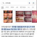 치아글에 과개교합? 쳐봤는데 증상이 난데..? 이미지