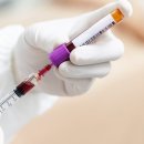 [Dr.이은봉의 의학 연구 다이제스트] 혈액검사 전 8시간 공복 못했어도… '혈당·중성지방' 말고는 별 차이 없어 이미지