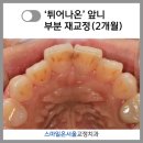 서울이나랑치과의원 | 재교정 기간, 과정, 비용, 방법, 후기 총정리 - 서울 재교정 전문 치과