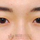 에이엠성형외과의원 네이버블로그