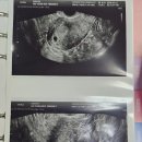 어리둥절! 초보임산부 03. 임신초기 아기집 보고, 보건소 다녀오기(+자궁근종)