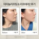 티타늄리프팅+리프테라2 유지 기간 및 이중턱 효과 내 돈 내산 한남동 프라이빗 피부과 후기