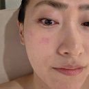 내돈내산 인천 편평사마귀 제거! 일주일 후기 및 재생 강추템