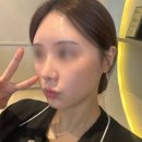 쏘인뷰티 | 내돈내산 리쥬란+스킨보톡스 후기｜3회티켓,효과,부작용,붓기,엠보,마취연고 or 수면마취 직접 해본...
