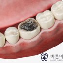 삼화복합빌딩 | 공릉역치과, 충치 단계별 통증은 어떻게 되며 어떤 증상이 있나요?