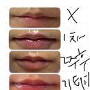 김송이의원 | [후기] 김송이의원 대표원장님 "입술필러/고백주사2x"