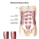 Abdominal Muscle Strain 이미지