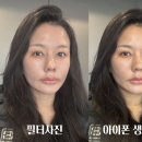 청담 피부과 소프웨이브 온다리프팅 온웨이브 효과 후기