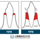 청량리 치주염 치료 잘하는 곳, 서울올바르다치과