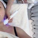 문정피부관리 | 보라다움에서 에스테틱 최초 합법 레이저 닥터밸루 6세대 엑소부스터 관리후기