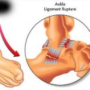발목이 아파요 지속되는 통증 끊어내기 위해서는 이미지
