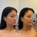 불당동일 | 천안 에스테틱 메리진 하이푸 후기 불당동 피부관리 추천