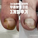 365늘봄메디칼의원 | [발톱무좀 3개월] 365늘봄메디칼의원 무좀치료교정후기 군포 의왕역 안양 안양역 부곡동 무좀치료전문...
