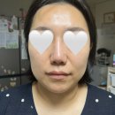 강동 우태하 피부과 올리온(국산 온다리프팅) 후기