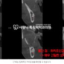 수원매복사랑니? 병원에서 뽑기 힘들단 말 들으신 분들만 [필독]