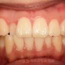 프라임에스치과교정과치과병원 | 덧니, 삐뚠 치아 발치 안하고 비발치로 교정 될까요? 부평교정후기