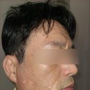 센텀모빅스피부과의원 | 남편의 백반증 치료, 부산 센텀모빅스 피부과 후기