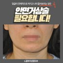 안면거상술잘하는병원 이라 안면거상술후기 많고 안면거상술가격 비용 마음에 듦 이미지