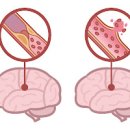 뇌졸중 전조증상 초기증상 원인 치료 예방 좋은음식 이미지
