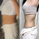 지방 | 대구 복부지방흡입 후기 1개월차 붓기, 멍, 통증 및 전후 경과