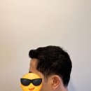 After 1 year turkey hair transplant from Korea