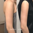 청담동 피부과 팔뚝 지방분해주사 라리컷주사 튠바디 고민해결