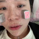 안의원 | 대전비염치료 안의원 코비한의원 실비 후기