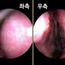 연세고른숨이비인후과 네이버블로그