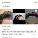 이마거상·안면거상 후 어색해진 헤어라인과 흉터, 자연스럽게 재건한 모발이식 후기