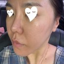 바른차를만드는사람들 | 인천 구월동피부과 쥬베룩 스킨 3cc 받고 피부탄력 달라진 후기
