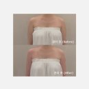 신남케어 | 청담에스테틱 디유에스테틱 청담점 팔뚝 슬리밍 관리 후기