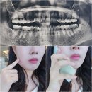 죽파치과의원 | 포항 매복사랑니 발치 후기 통증 회복과정 주의사항