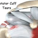 어깨 회전근개 파열 증상 / 왼쪽 오른쪽 어깨 통증 원인 (힘줄, 수술) 이미지