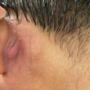 귀 뒤 염증 찌릿 원인 귀 뒤 임파선 부었을 때 이미지