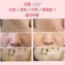 리블MTS(히알루론산+PDRN+펩타이드+EGF) 4주 똑똑한 신호등앰플 MTS 오픈 / 보습, 탄력, 모공, 수분...
