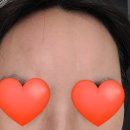 케이원메디(K1MEDI) | 쥬얼리 성형외과 메디 쥬얼리(Medi Jewerly) 콜라겐 앰플 사용 후기