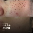 소로3-135(혁신도시) | [대구 동구] 혁신도시 색소침착엔 콜드 플라즈마...높았던 '뷰티온화' 솔직후기 (10일분 전,후 사진있음)