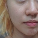 멍들리 | 강남역 피부과 인모드 후기 / 신논현 피부과