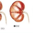 급성 신부전[acute renal failure] 이미지