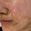 약초명가&스킨케어 | 천안 백석동 여드름 케어 약초소프트필링 후기 이정희 스킨케어