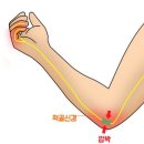 팔꿈치터널증후군 이미지