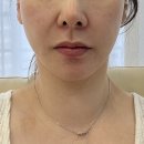 다녀올개 | 강남역 피부과 올타이트 순자리프팅과 레티젠콜라겐 효과 가격